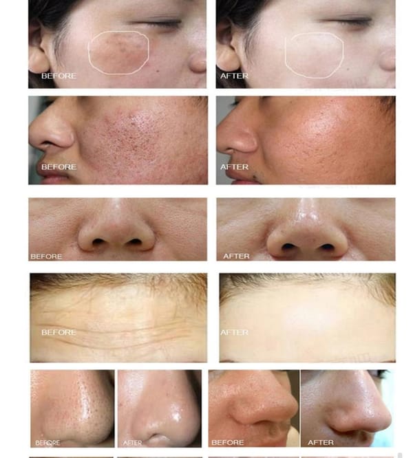 before and after hydra facial