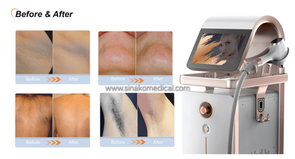 Before and After medical CE certified diode laser hair removal treatment