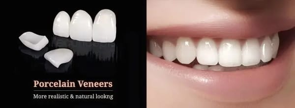 Porcelain Veneers Porcelain Veneers