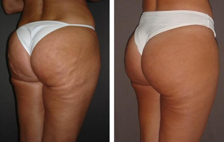 Cellulite removal with carboxy therapy