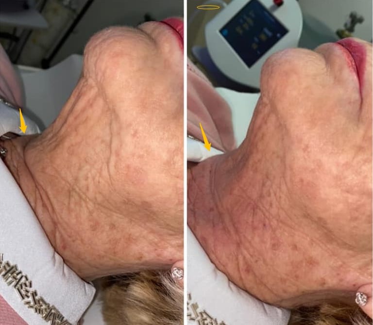 Carboxy therapy treatment results