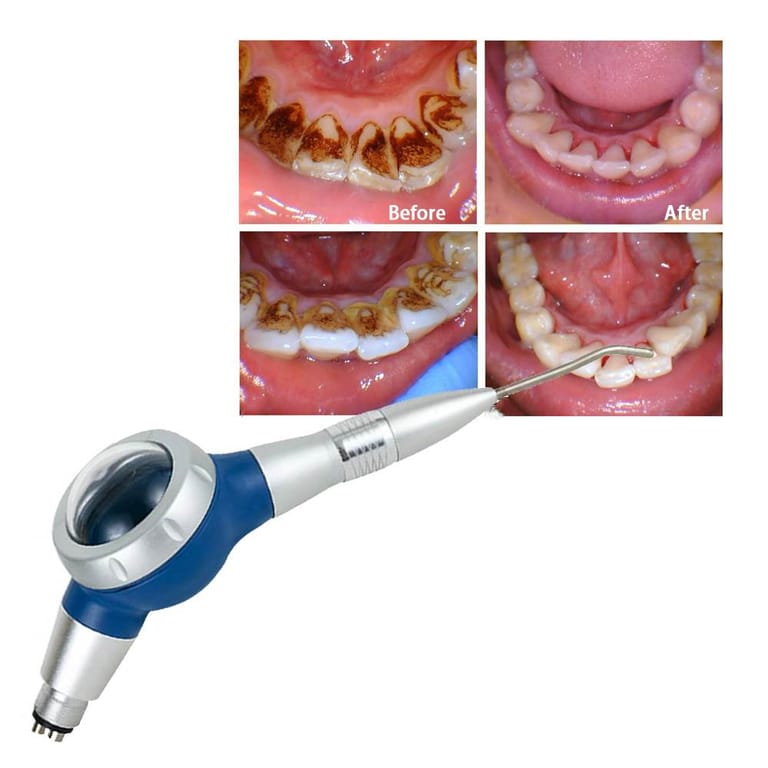 Blue Dental Air Prophy Jet Air Polisher, Before and After Teeth Cleaning Stain Removal Effect Blue Dental Air Prophy Jet Air Polisher, Before and After Teeth Cleaning Stain Removal Effect