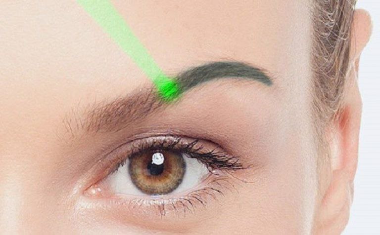Laserowe usuwanie MP brwi