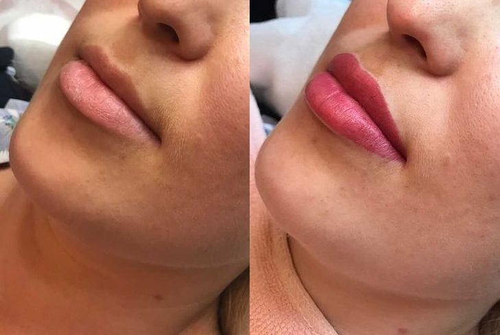 Laserowe usuwanie permanentnego makijażu ust