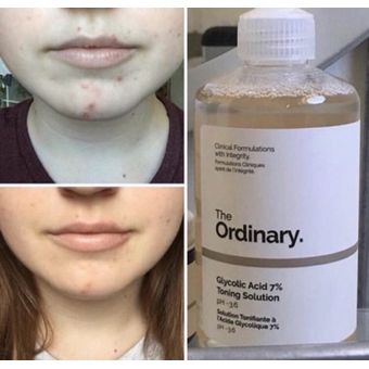 The Ordinary Glycolic Acid 7% Toning Solution 