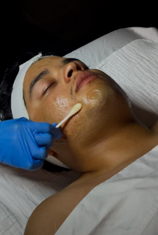 Chemical Peel