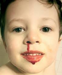 posterior nasal bleed الرعاف نزيف الانف