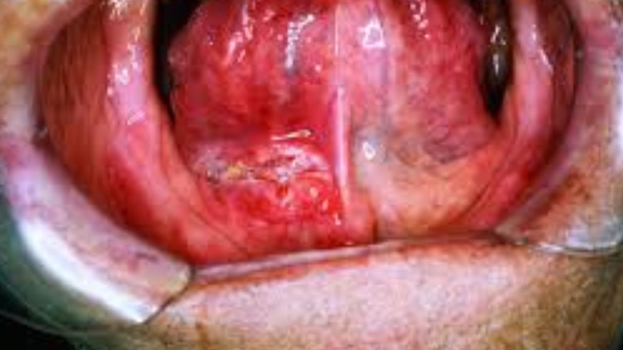painful mouth ulcer قرحة الفم المؤلمة