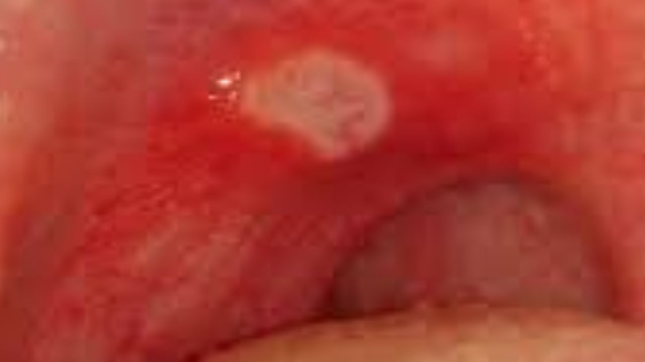 painful mouth ulcer قرحة الفم المؤلمة