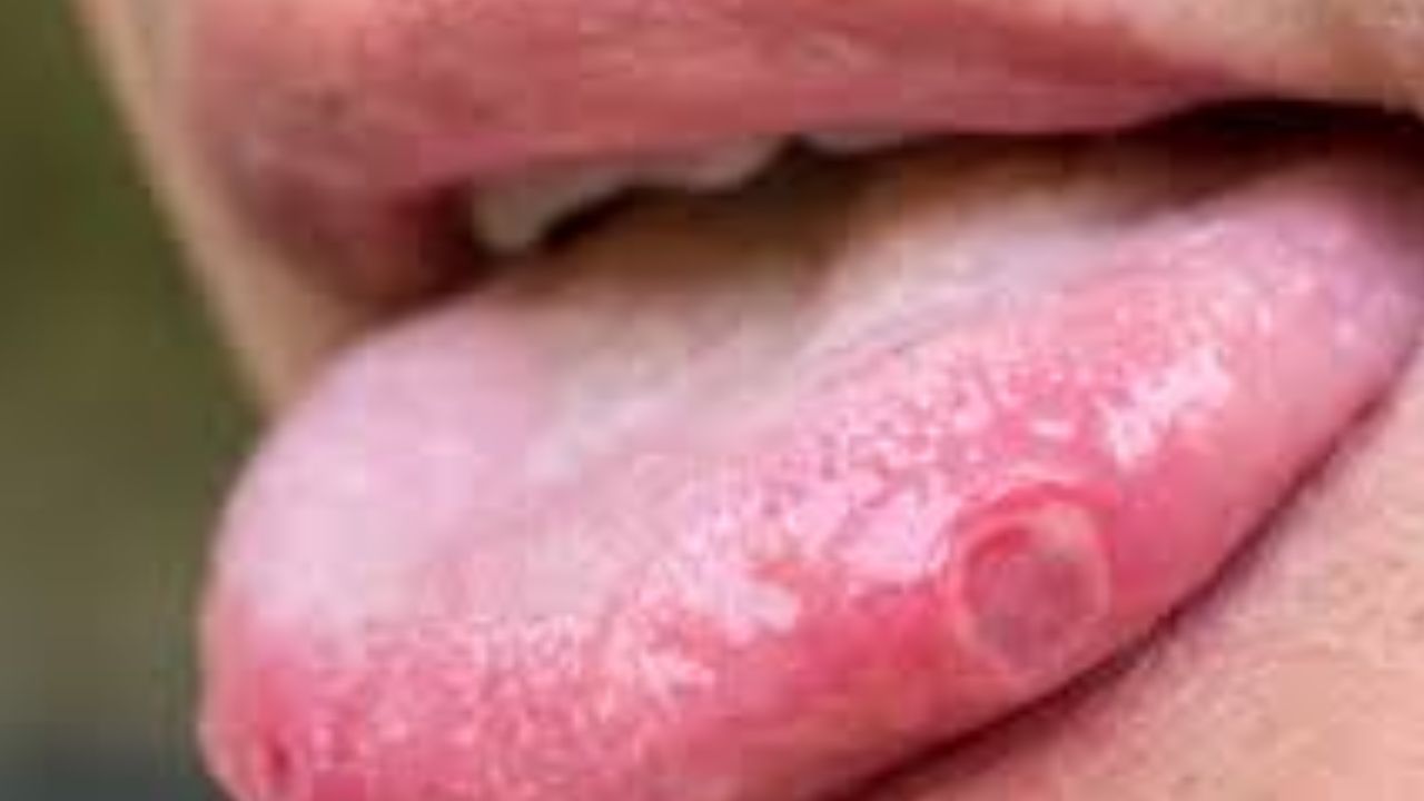painful mouth ulcer قرحة الفم المؤلمة