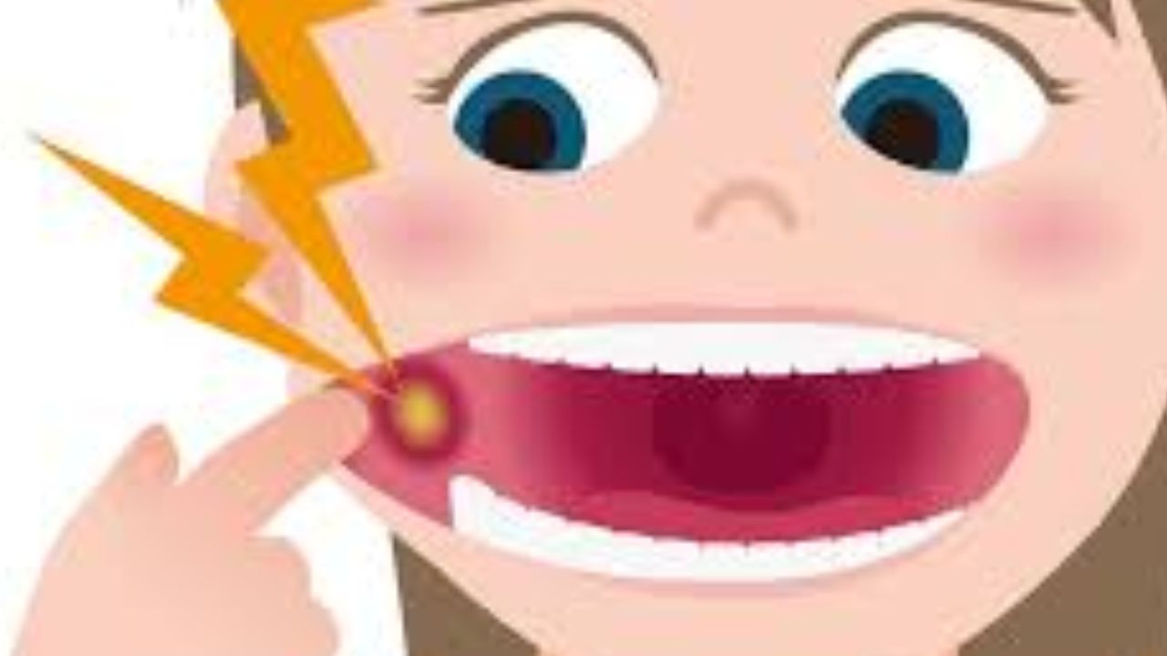 painful mouth ulcer قرحة الفم المؤلمة