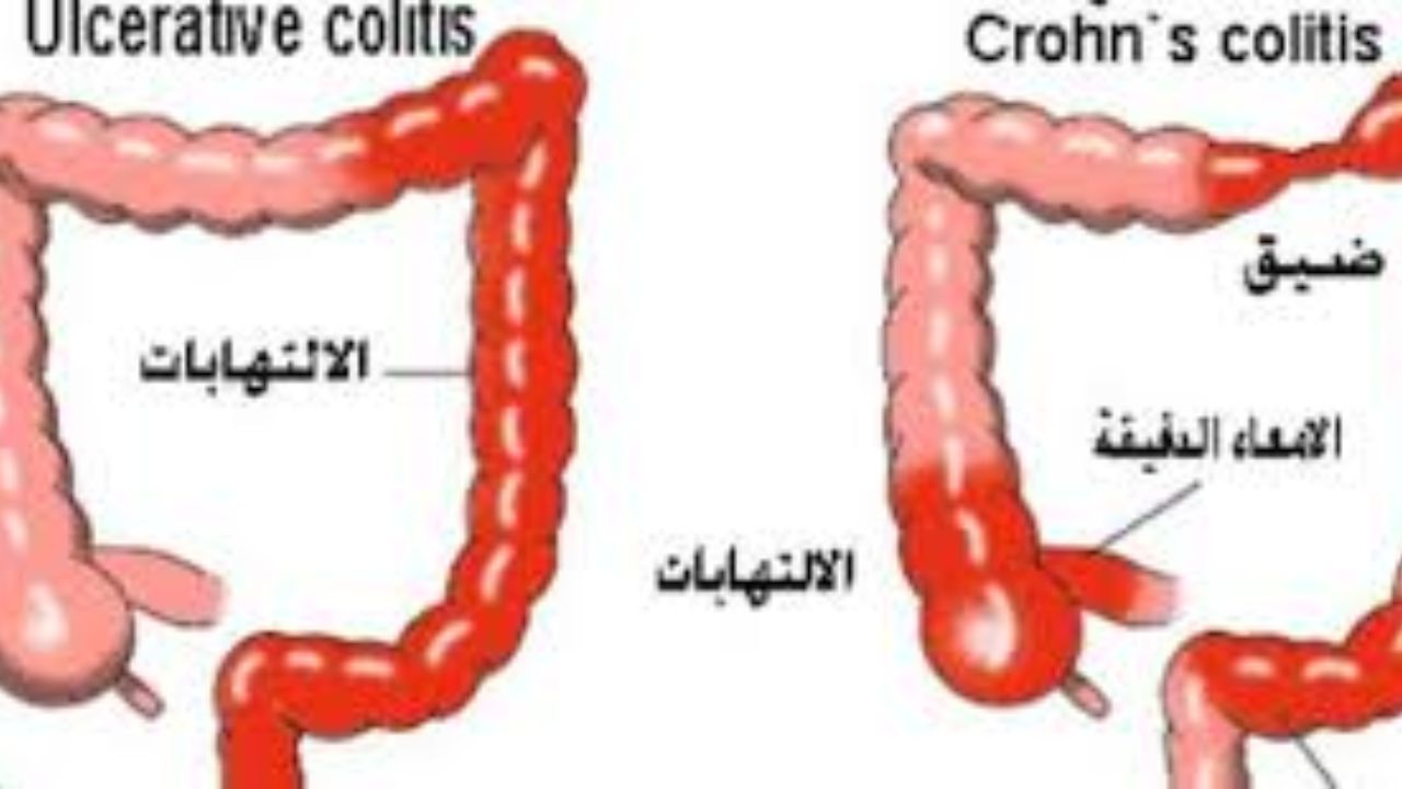 Atypical Treatment for Colorectal Conditions العلاج غير التقليدي لأمراض القولون والمستقيم