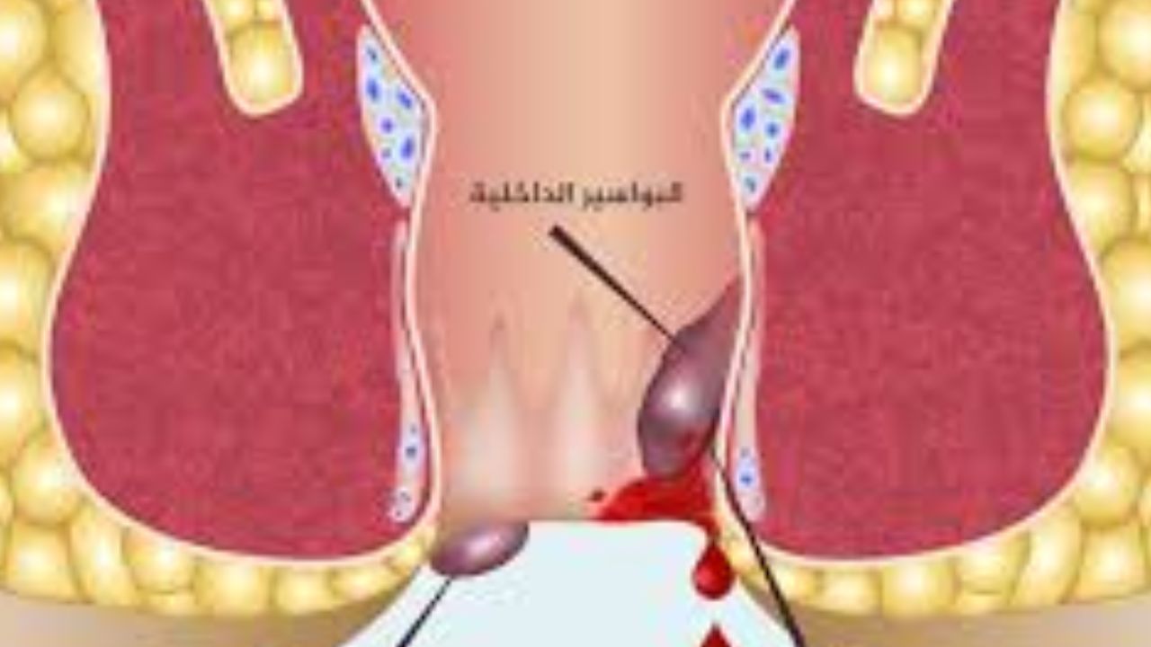 Atypical Treatment for Colorectal Conditions العلاج غير التقليدي لأمراض القولون والمستقيم