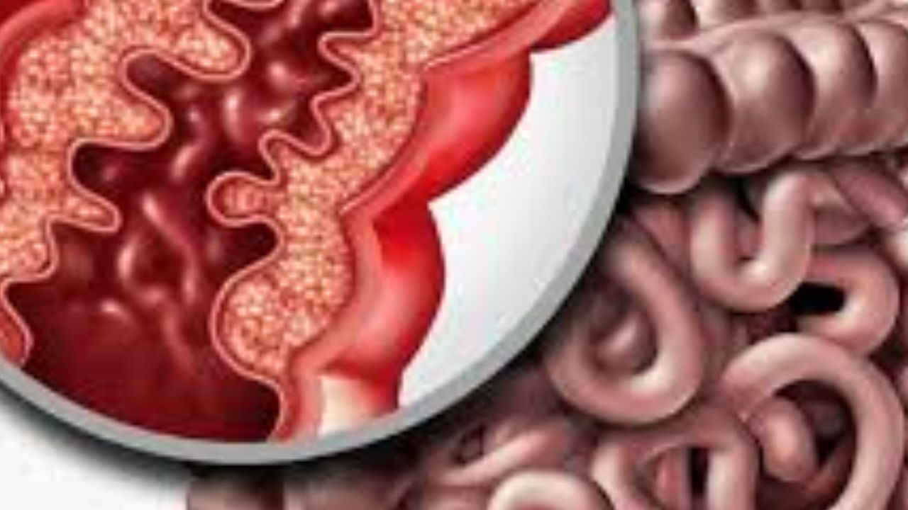 Atypical Treatment for Colorectal Conditions العلاج غير التقليدي لأمراض القولون والمستقيم