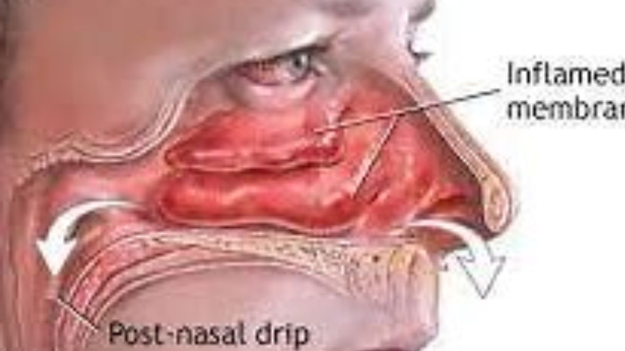  the way of Dr. Hassan Al-Waraqi of Sore throat treatment  طريقة الدكتور حسن الوراقي في علاج التهاب الحلق
