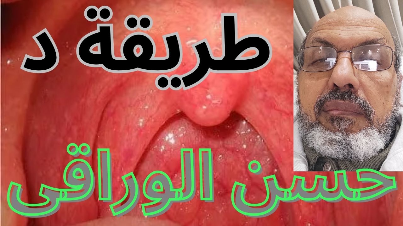  the way of Dr. Hassan Al-Waraqi of Sore throat treatment  طريقة الدكتور حسن الوراقي في علاج التهاب الحلق