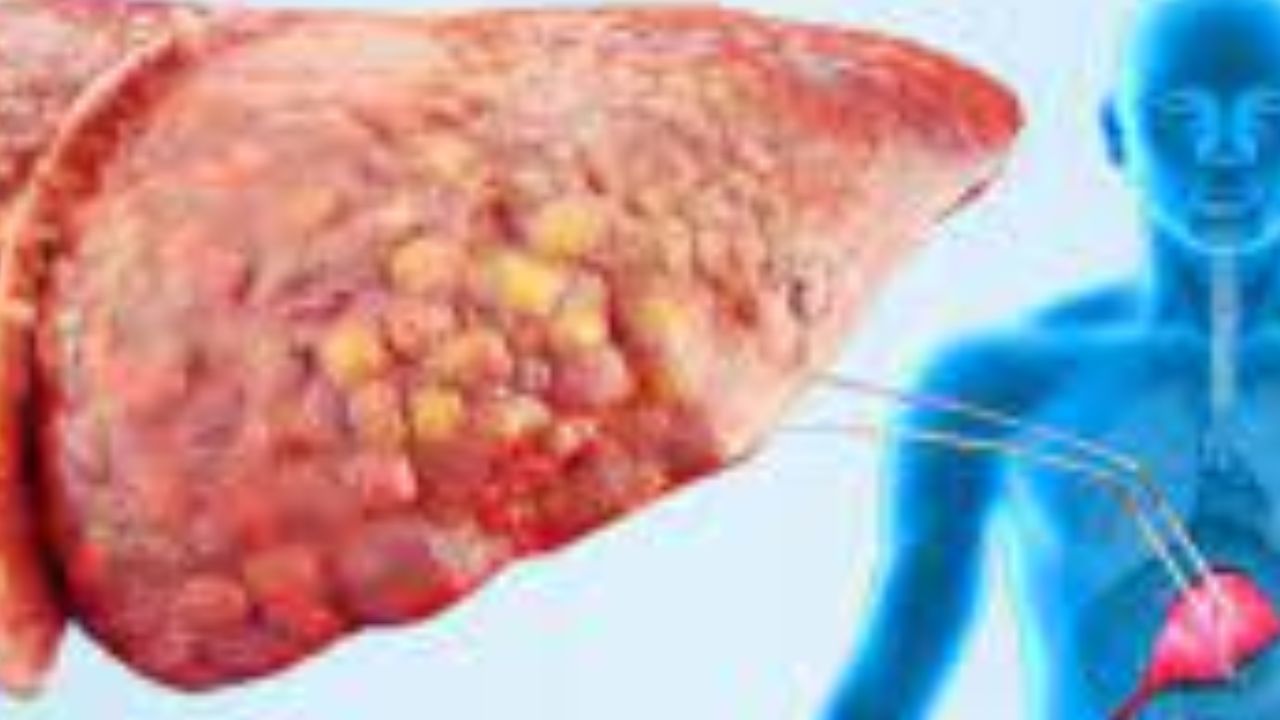 fatty liver الكبد الدهني