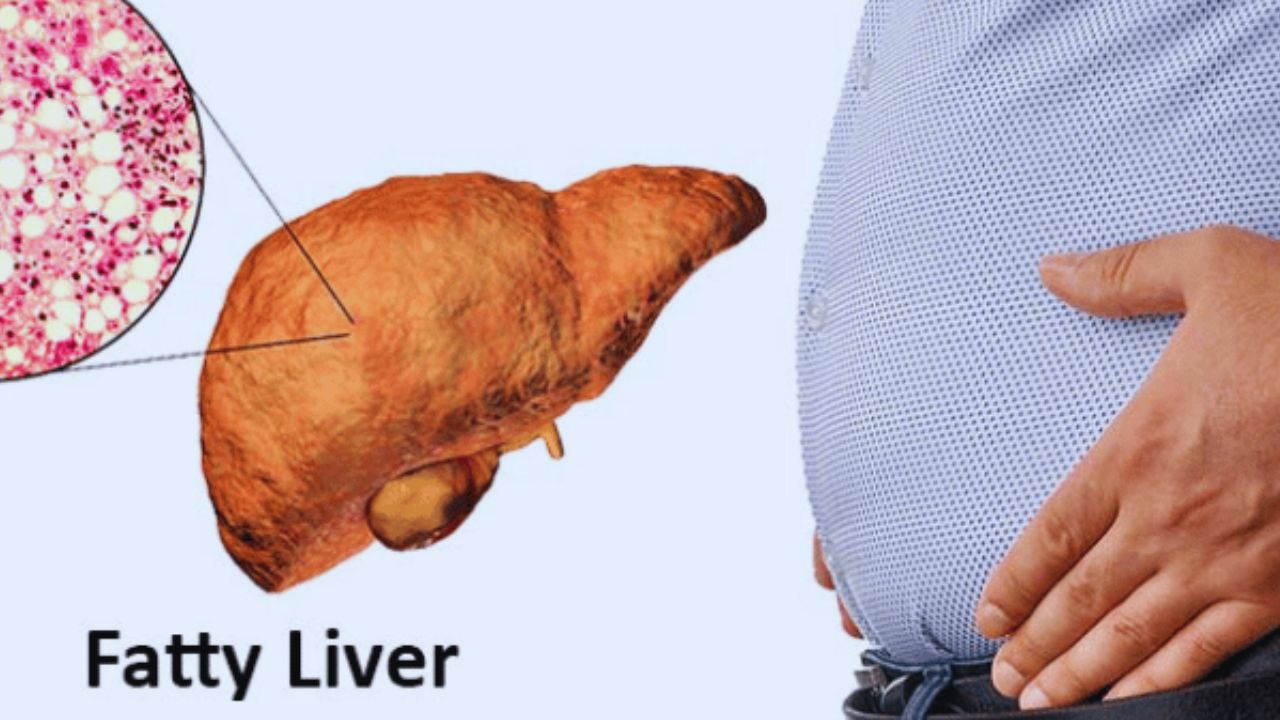 fatty liver الكبد الدهني