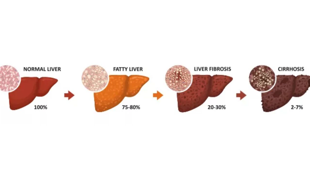 fatty liver الكبد الدهني