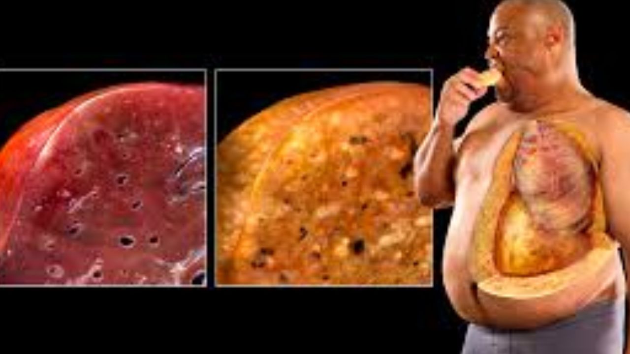 fatty liver الكبد الدهني
