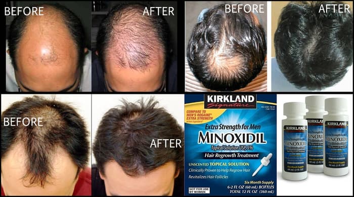 KIRKLAND MINOXIDIL 5% TIRPALAS PLAUKŲ AUGIMUI 6 x 60ml