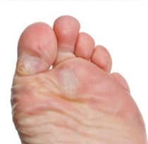 Nuospaudų šalinimas