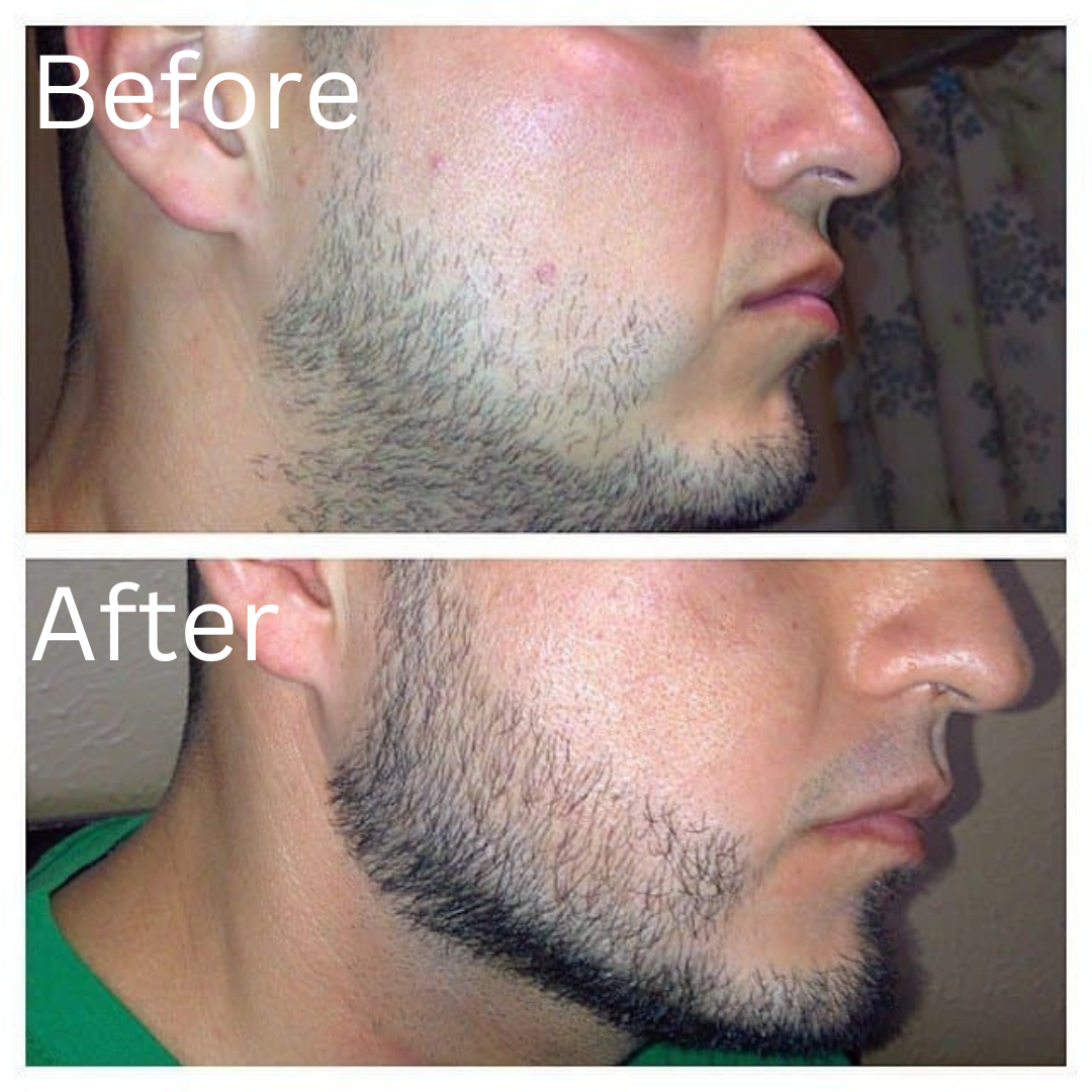 1 Month - Hair Growth Treatment