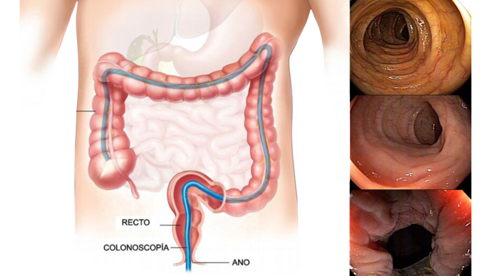 Colonoscopio EC – 580RD