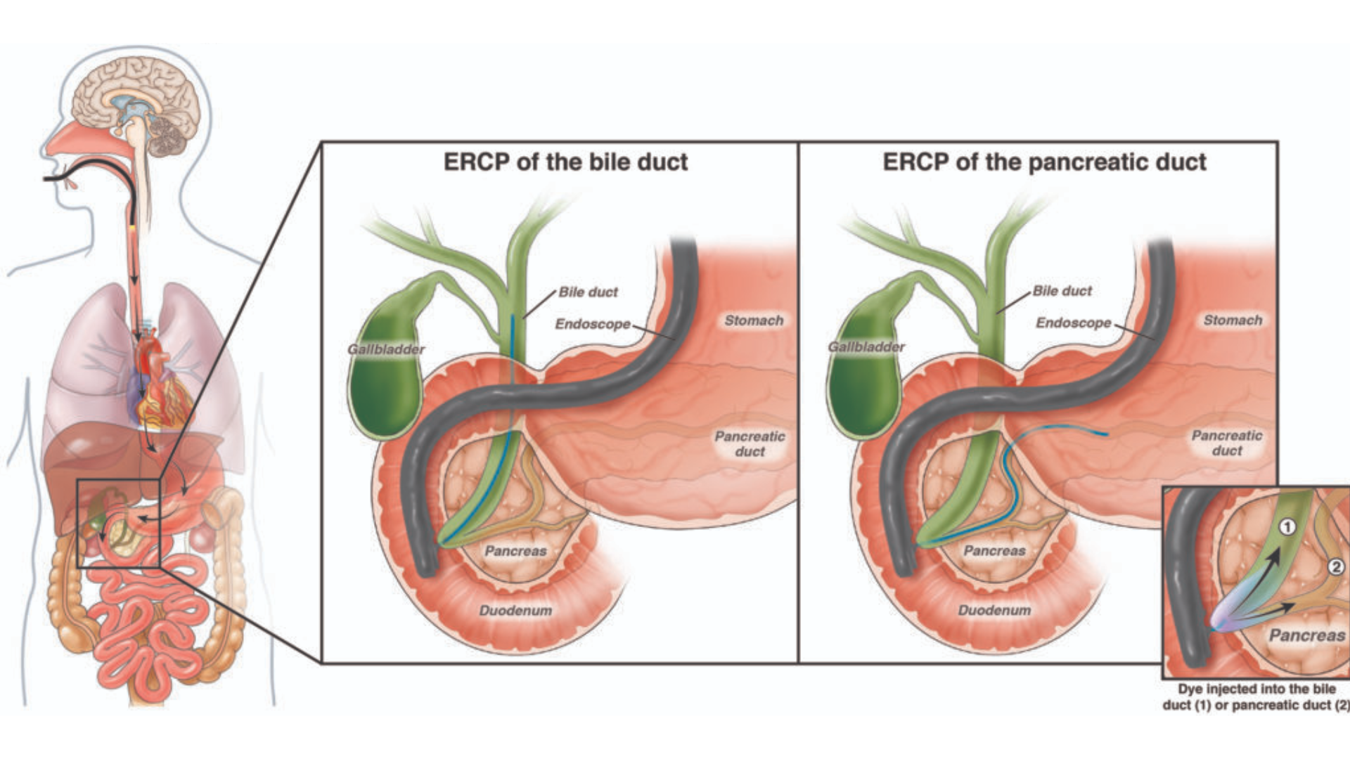 Duodenoscopio ED-580XT