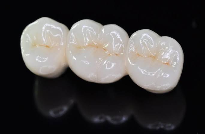 Pontes dentárias 3 elementos