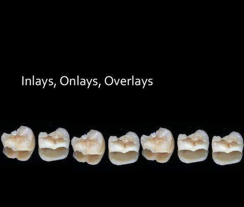 Onlaws e inlays em cerâmica pura
