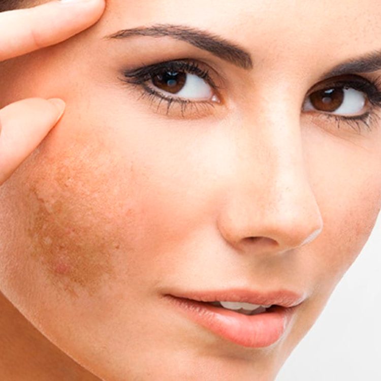 Tratamientos para Manchas