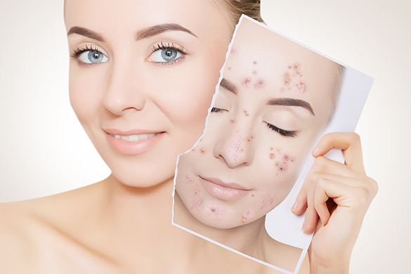 Tratamiento de Acné