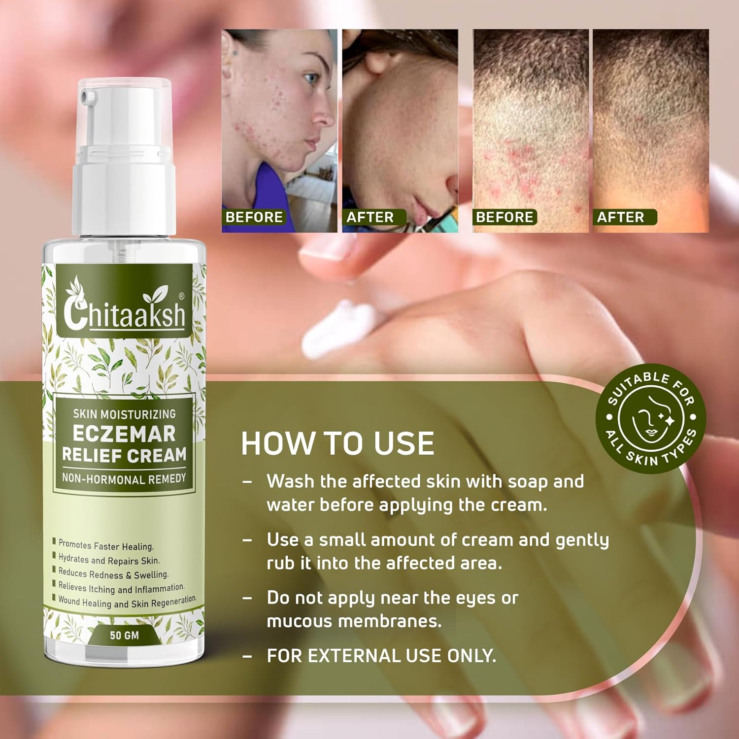 Chitaaksh Eczemaron Fungal Cream For Men & Women Ayurvedic Itchcoat Anti Fungal Malam For Ringworm Itching Eczema Cream For Face, Hand & Body (50 Gm)