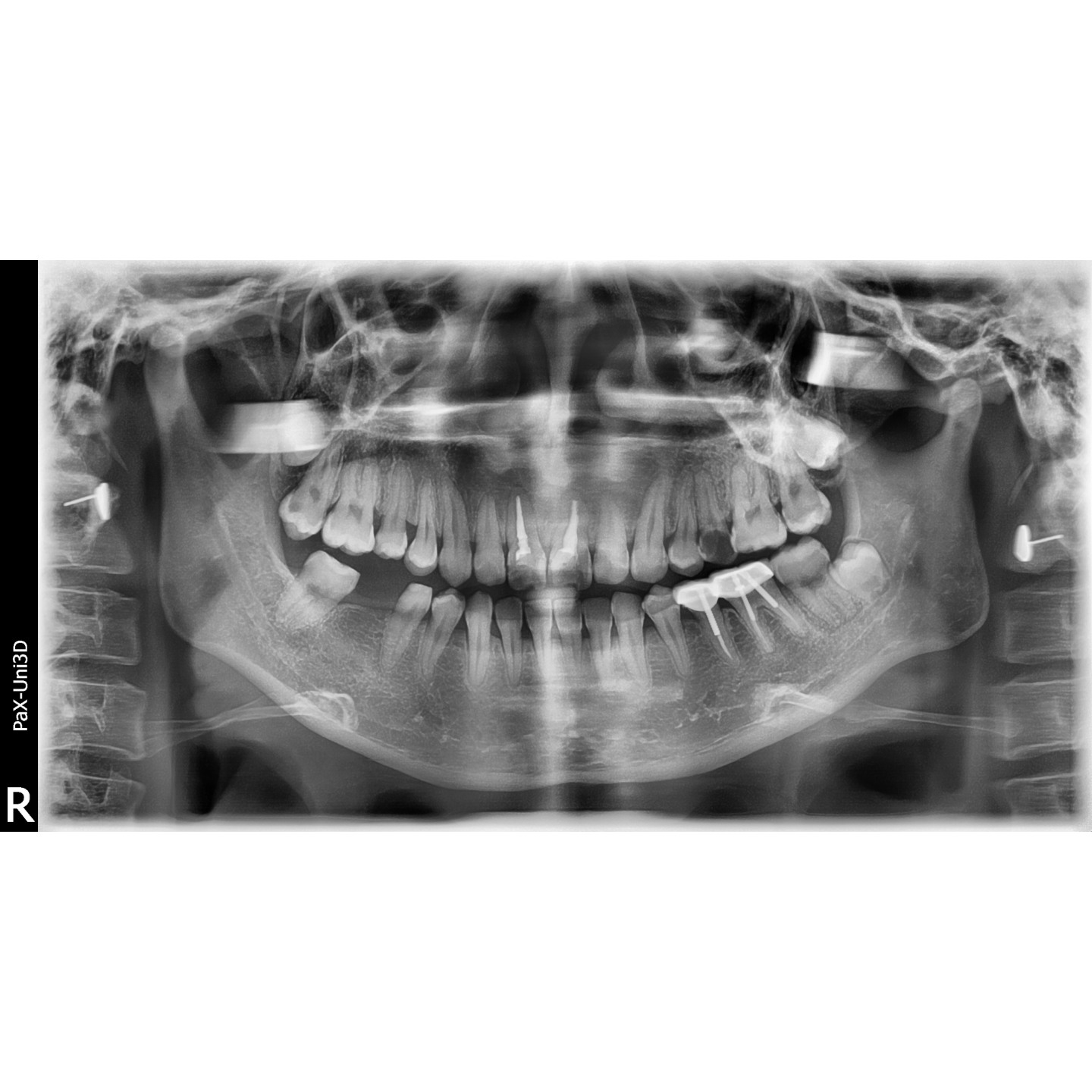 Vatech PaX-Uni3D Used Dental Pano+Ceph+CBCT