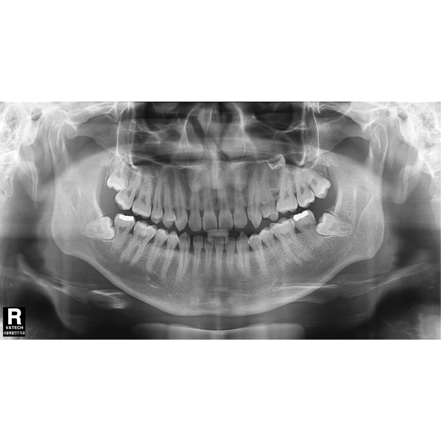 Vatech Implagraphy Used Dental Pano+Ceph+CBCT