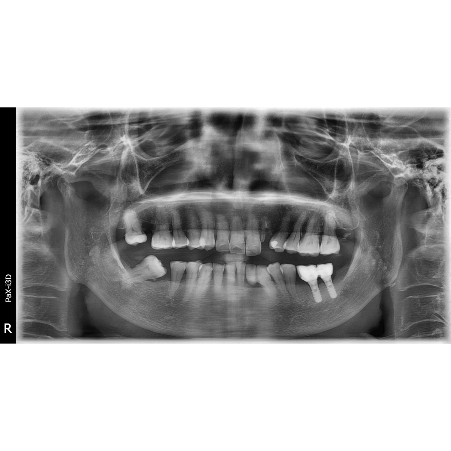 Vatech PaX-i3D SC Used Dental Pano+Ceph+CBCT