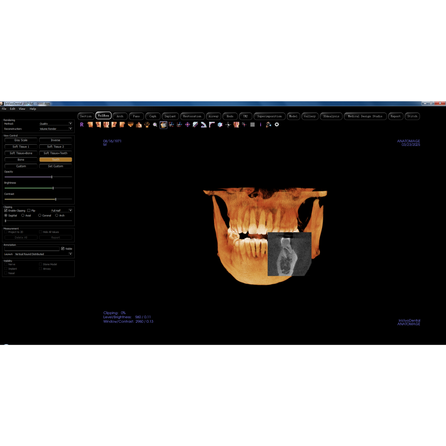 Fussen Dentrix 20 Used Dental CBCT