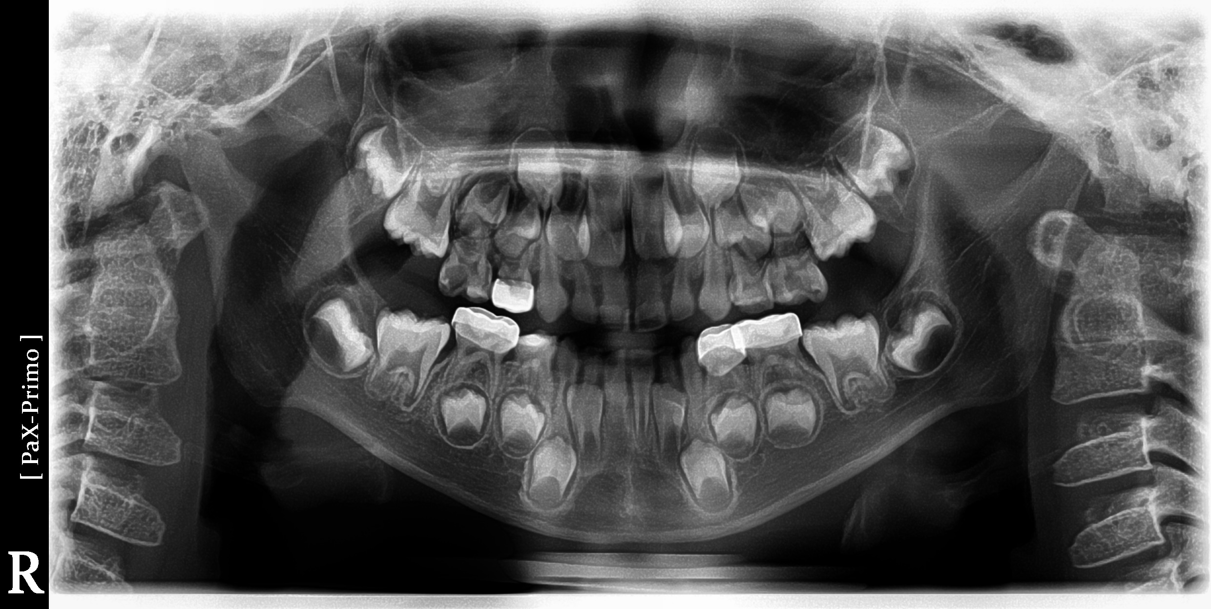 Vatech Primo Máy chụp X-quang Toàn cảnh Nha khoa Đã qua sử dụng