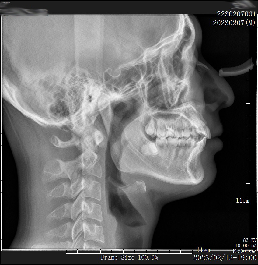 Genoray PAPAYA Plus Máy Chụp X-quang Nha Khoa Toàn Cảnh + Sọ Nghiêng Đã Qua Sử Dụng