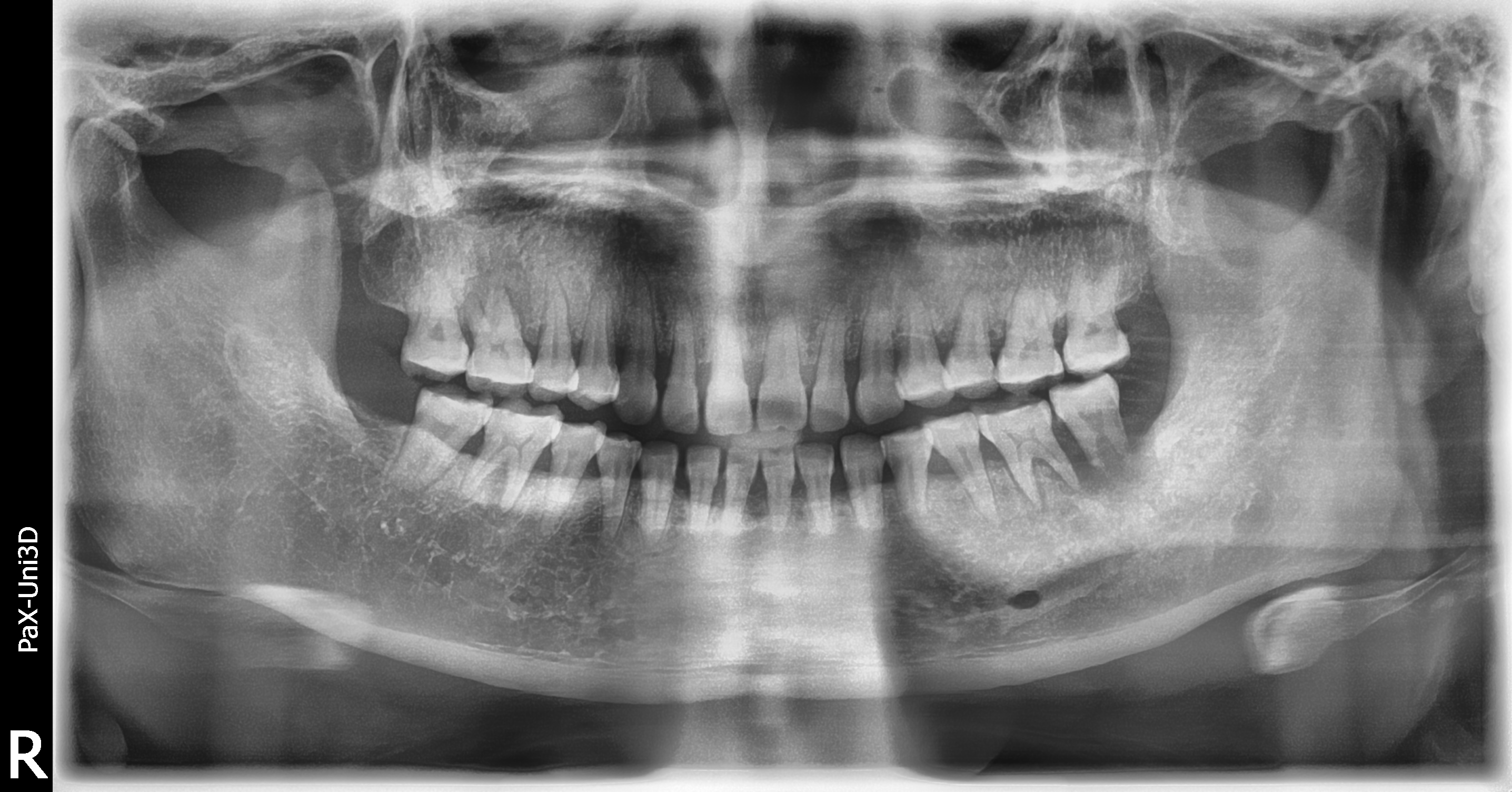 二手CBCT 怡友PaX-Uni3D全景+CBCT