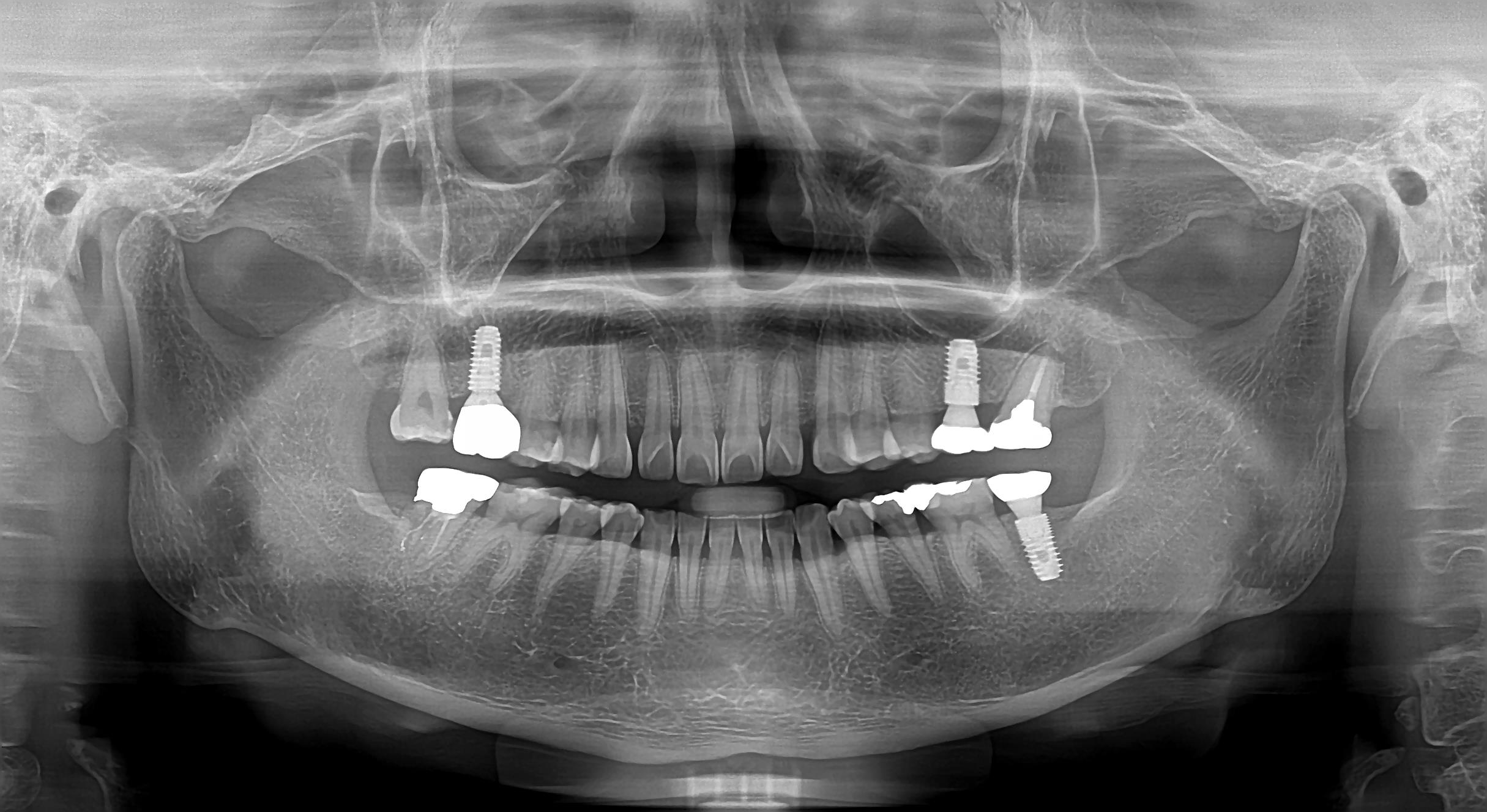 Dental X-ray Imaging Machine