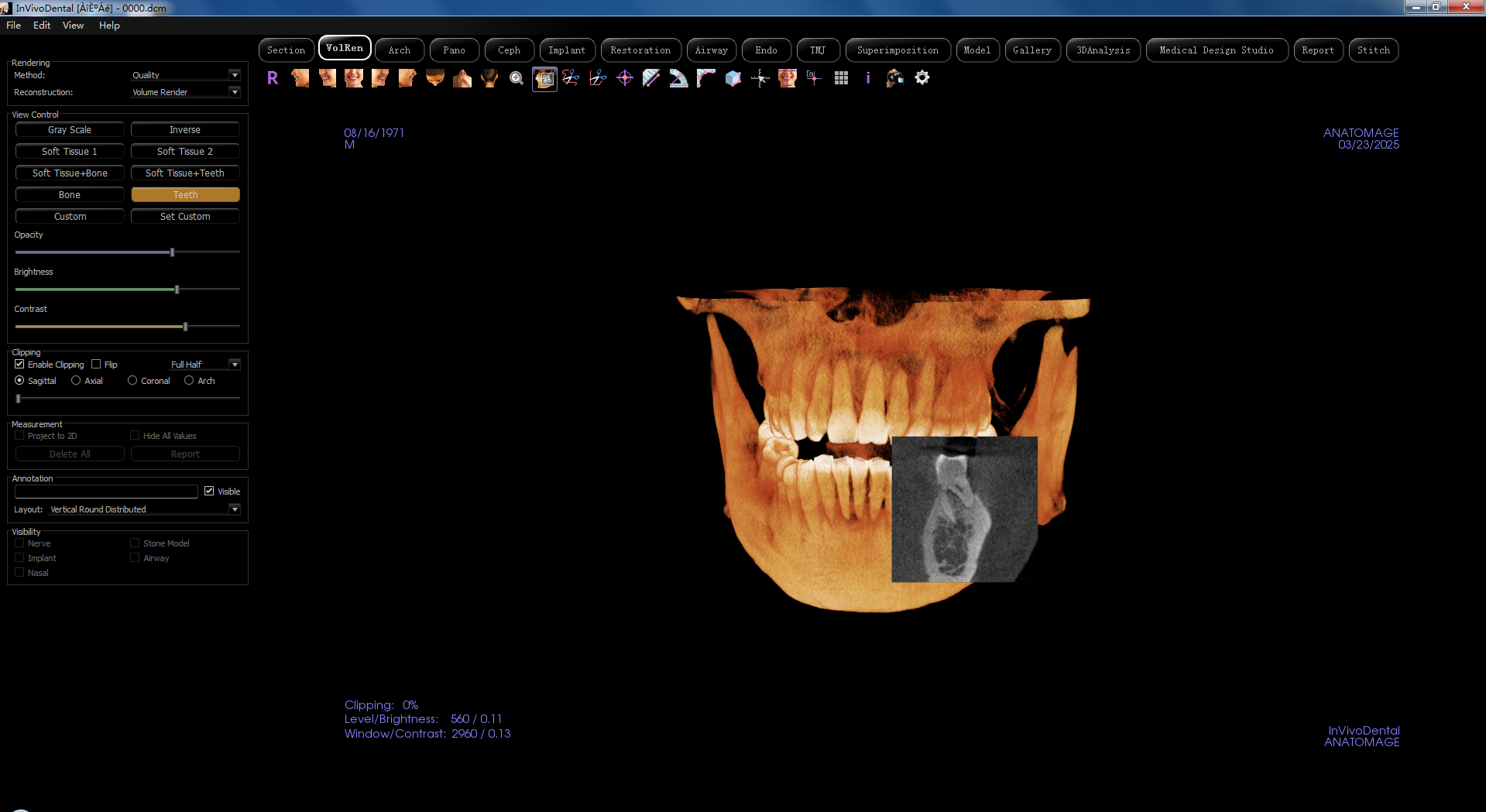 二手CBCT菲森Dentrix 20 CBCT