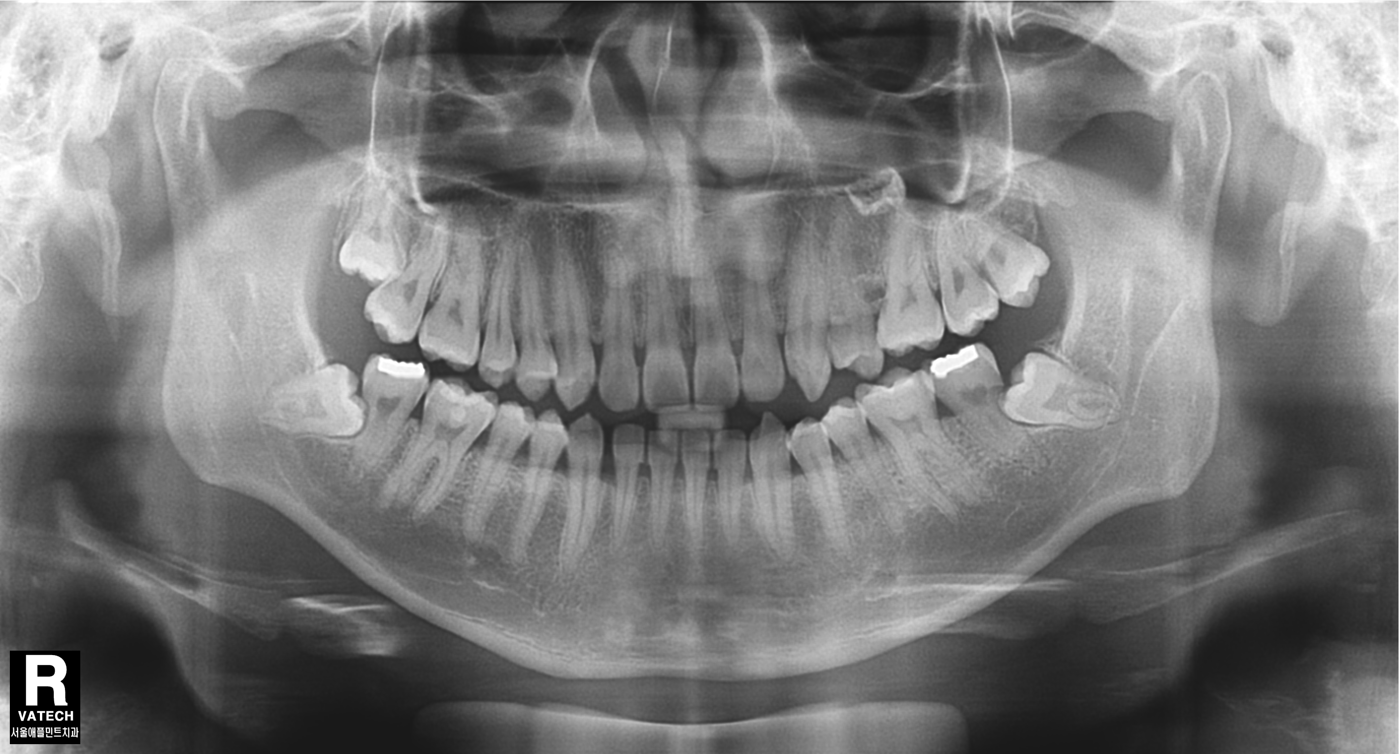 Vatech Implagraphy – Máy toàn cảnh + Ceph + CBCT nha khoa đã qua sử dụng