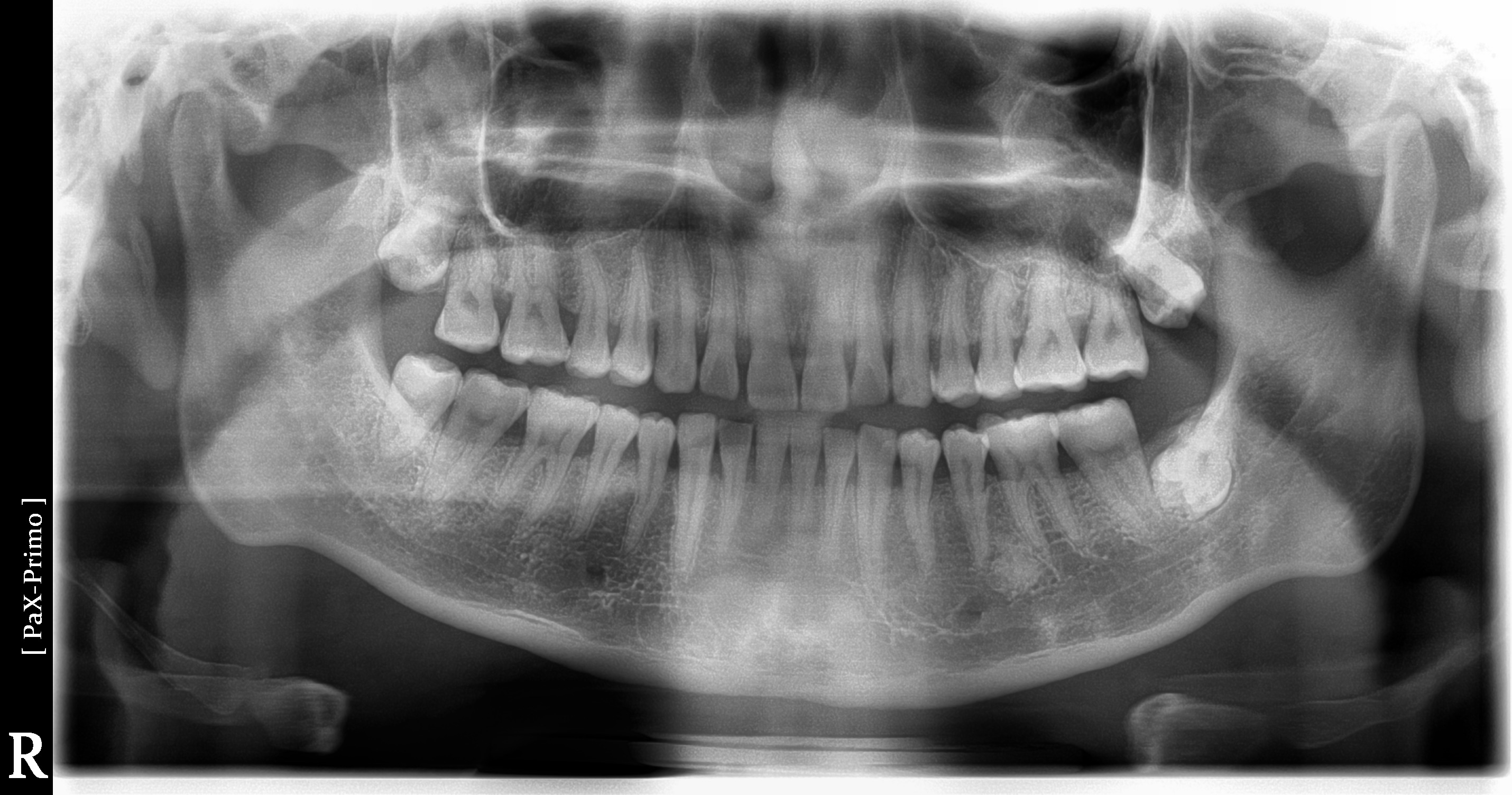 Vatech Primo Máy chụp X-quang Toàn cảnh Nha khoa Đã qua sử dụng