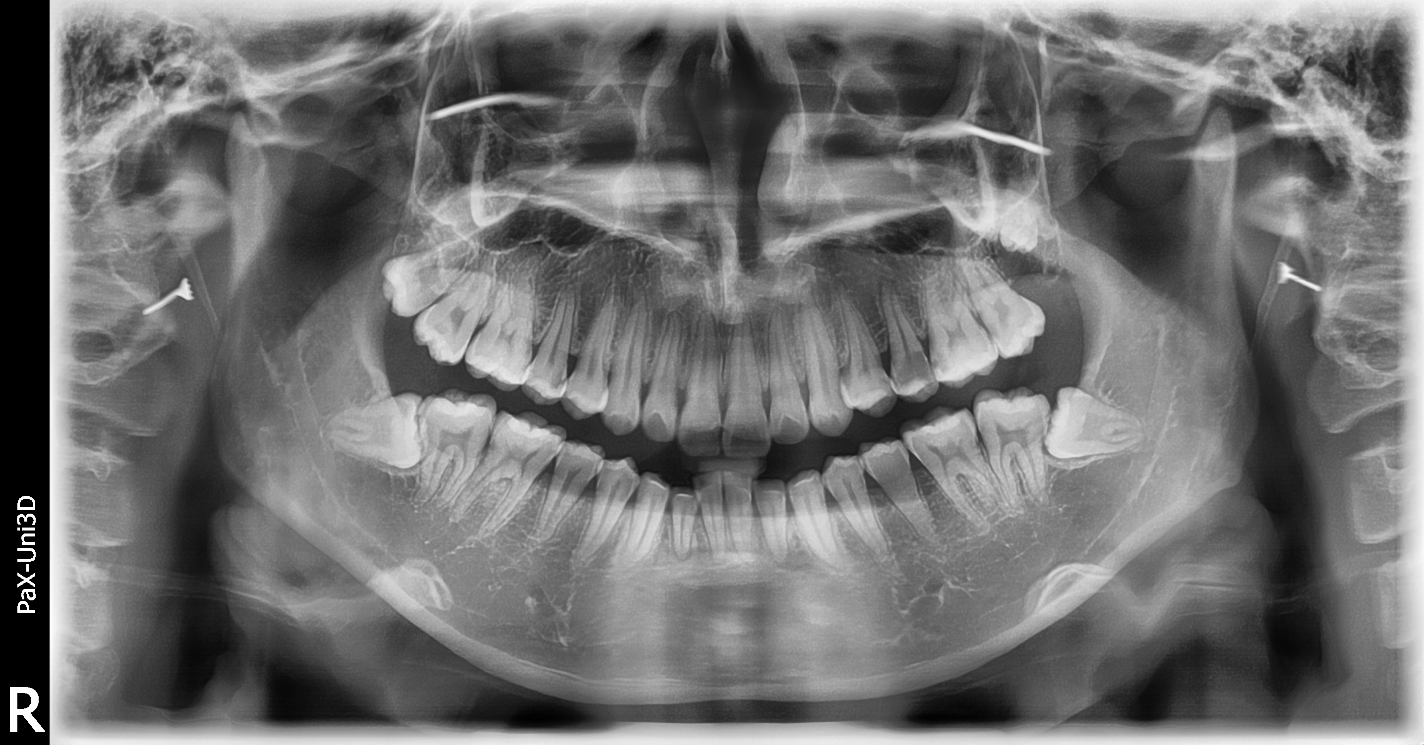 二手CBCT 怡友PaX-Uni3D全景+CBCT