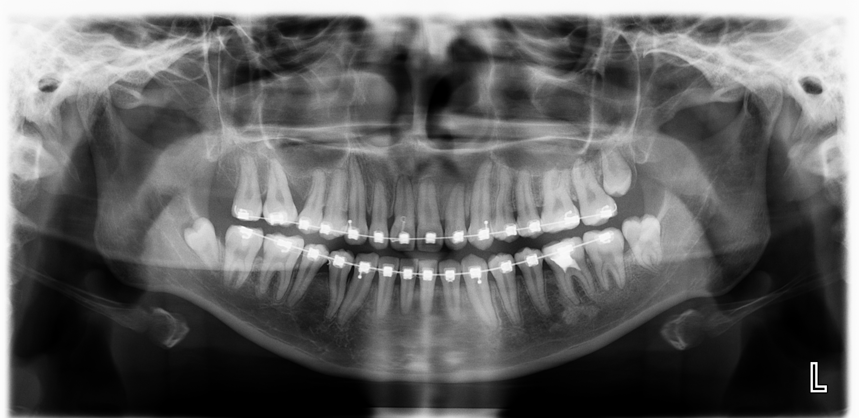 Máy Planmeca ProMax Chụp X-quang Nha Khoa Toàn Cảnh + Sọ Nghiêng Đã Qua Sử Dụng