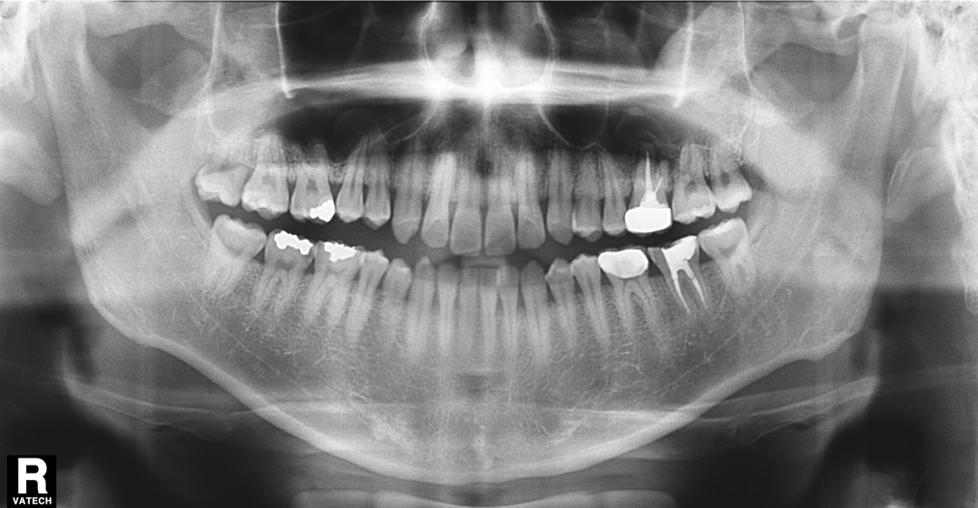 Vatech Implagraphy – Máy toàn cảnh + Ceph + CBCT nha khoa đã qua sử dụng
