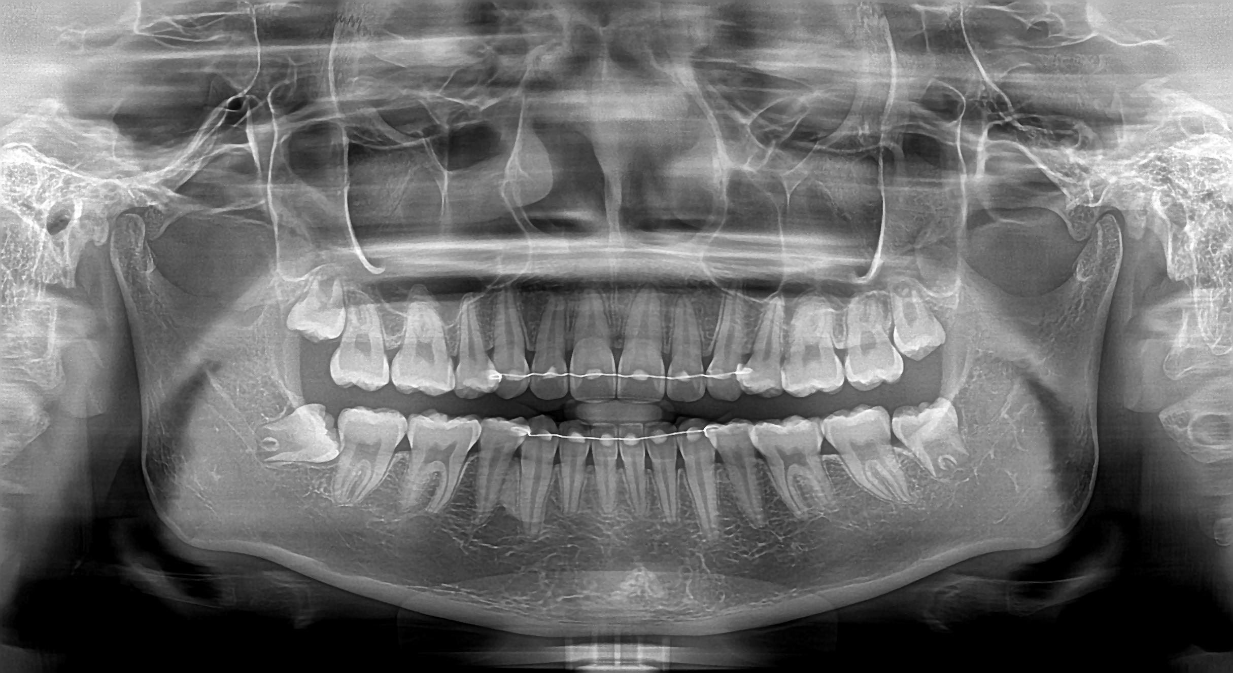Dentium Rainbow CT – 3-in-1 Dental CBCT System Used Dental CBCT