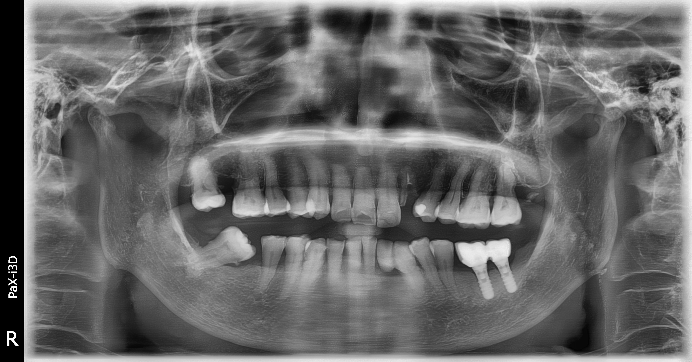 Vatech PaX-i3D SC – Máy toàn cảnh + Ceph + CBCT nha khoa đã qua sử dụng